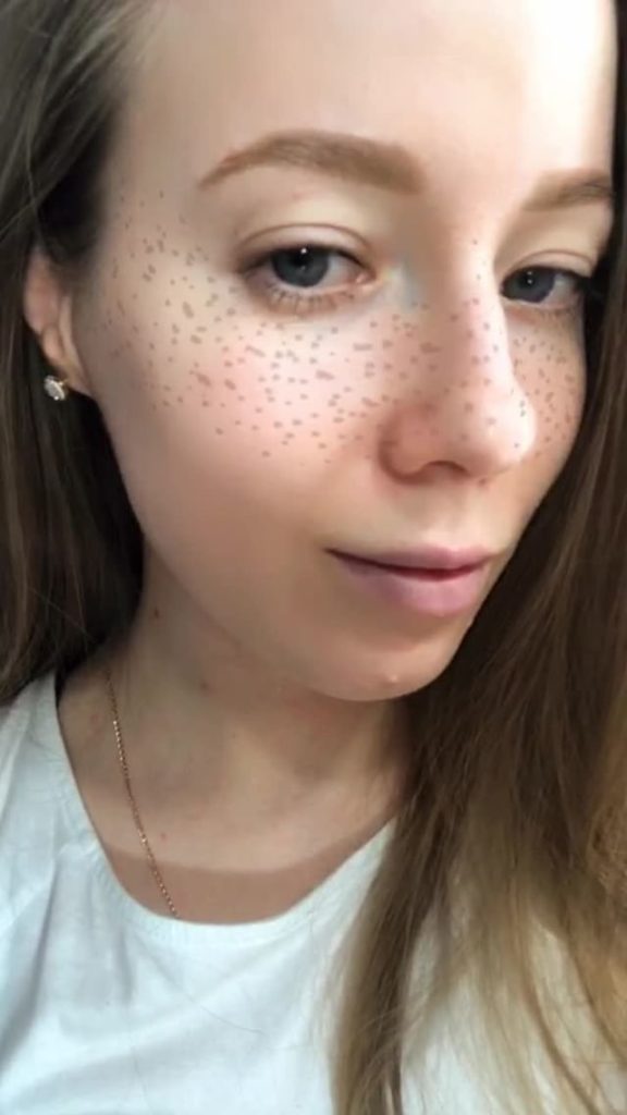 Freckles