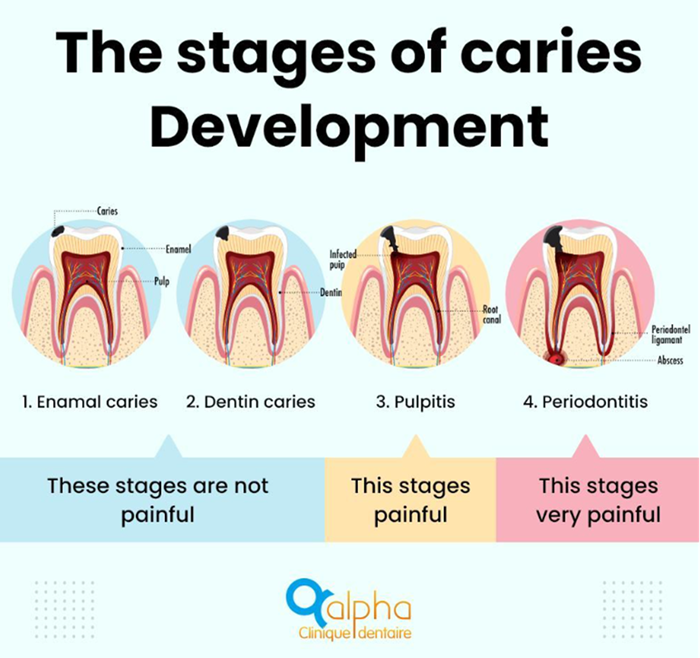 Instagram post by a dental clinic illustrating the Stages of caries development